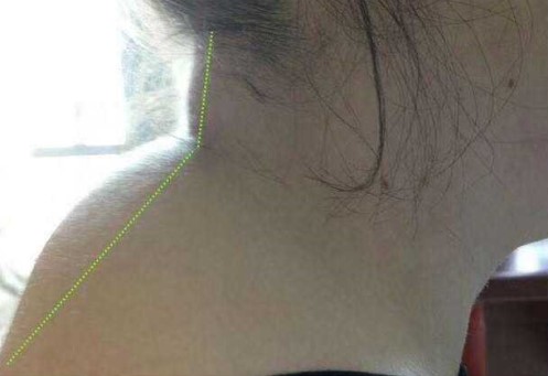 推拿怎么治疗富贵包,富贵包怎么推拿消除最有效