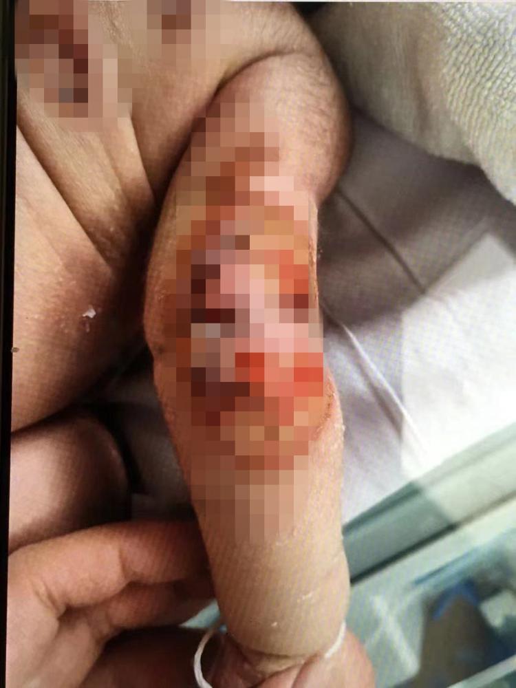 出生23天婴儿洗澡病危后续,男婴被烫伤后续