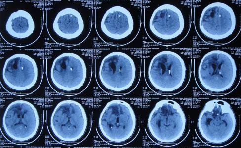 开颅手术后颅内细菌感染图片,外伤开颅手术后脑积液能恢复吗