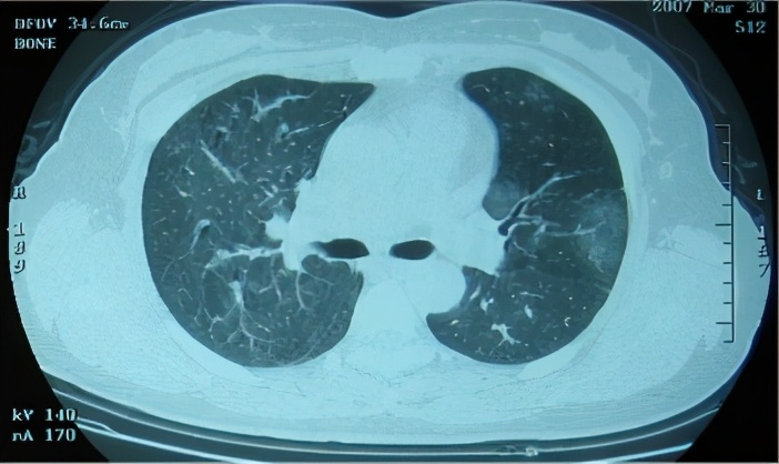 养鸽子造成皮肤真菌感染,养鸽子会得肺炎吗