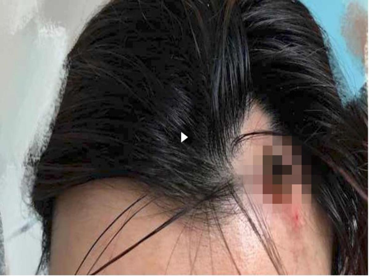 千万不要做减重手术,千万不要做自体脂肪填充