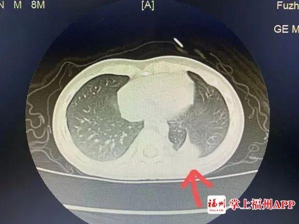 宝宝咳嗽伴有反复发烧福州,1岁8个月宝宝反复发烧肺部有痰