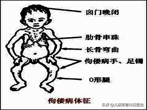 孩子走路太早对腿有什么伤害,宝宝站立早会罗圈腿吗