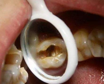 孩子有牙痛的症状怎么办,孩子牙痛解决方法