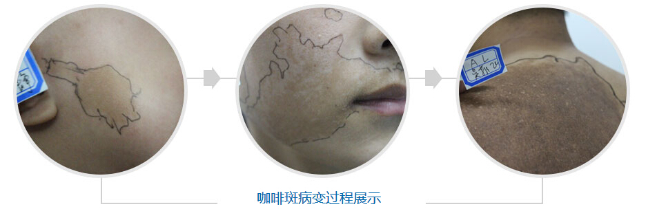 宝宝脸上咖啡斑治不好吗,咖啡斑为什么治不好