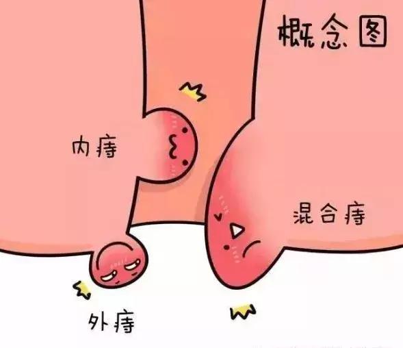 肛肠科普：血栓外痔