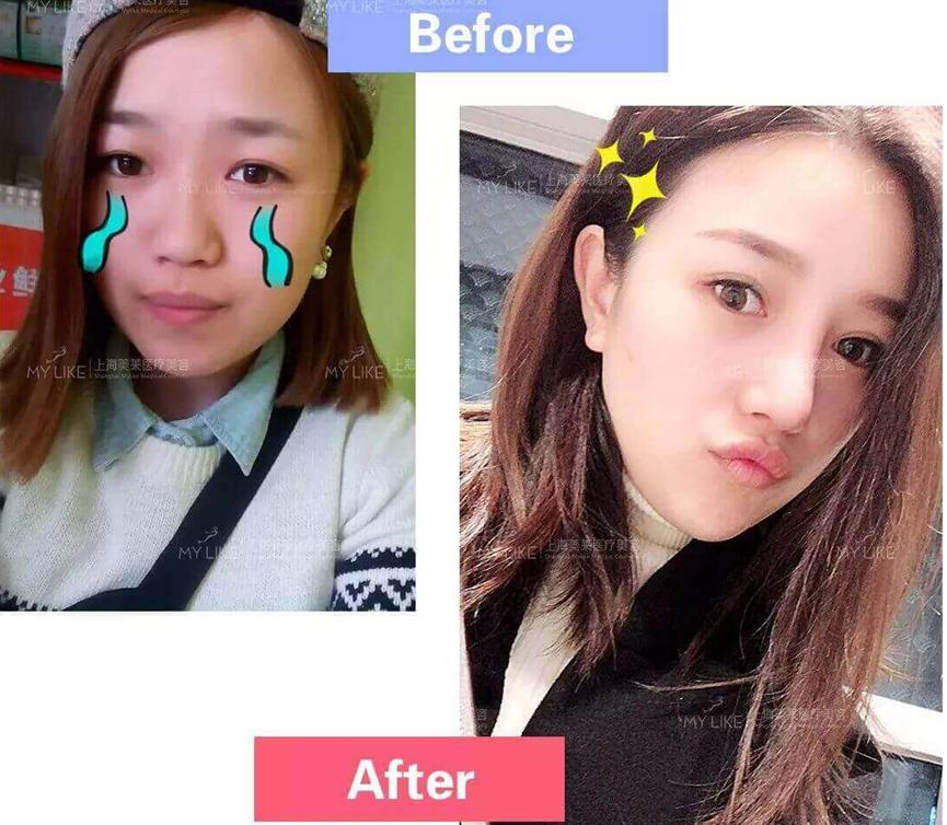 网红整容去世背后的医美生意：暴利、欺诈、占领县城