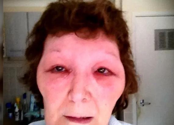 英国女子被假医生注射肉毒杆菌，脸部肿胀像外星人，差点丧命