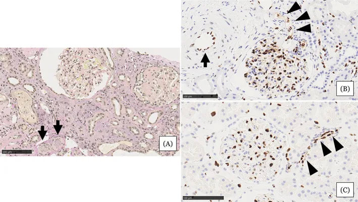干细胞治疗肾最新临床进展,干细胞能彻底治愈慢性肾损伤吗