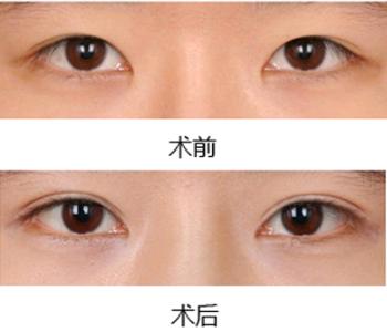 双眼皮埋线优点和缺点,平扇双眼皮优点和缺点