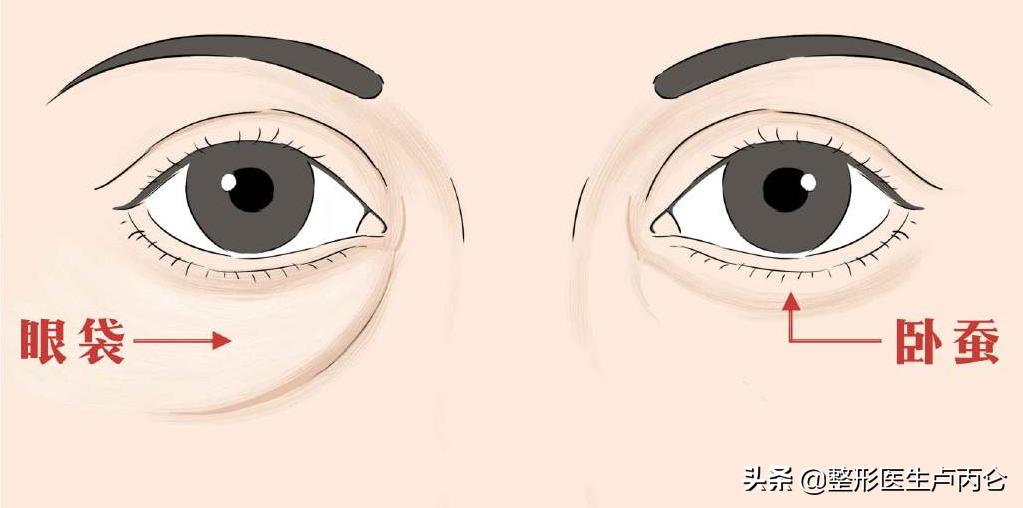 外切眼袋有哪些并发症,眼袋手术有可能出现哪些并发症