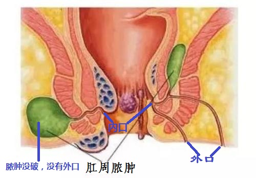 肛周脓肿有多少的几率变成肛瘘,肛周脓肿有多大的几率发展成肛瘘