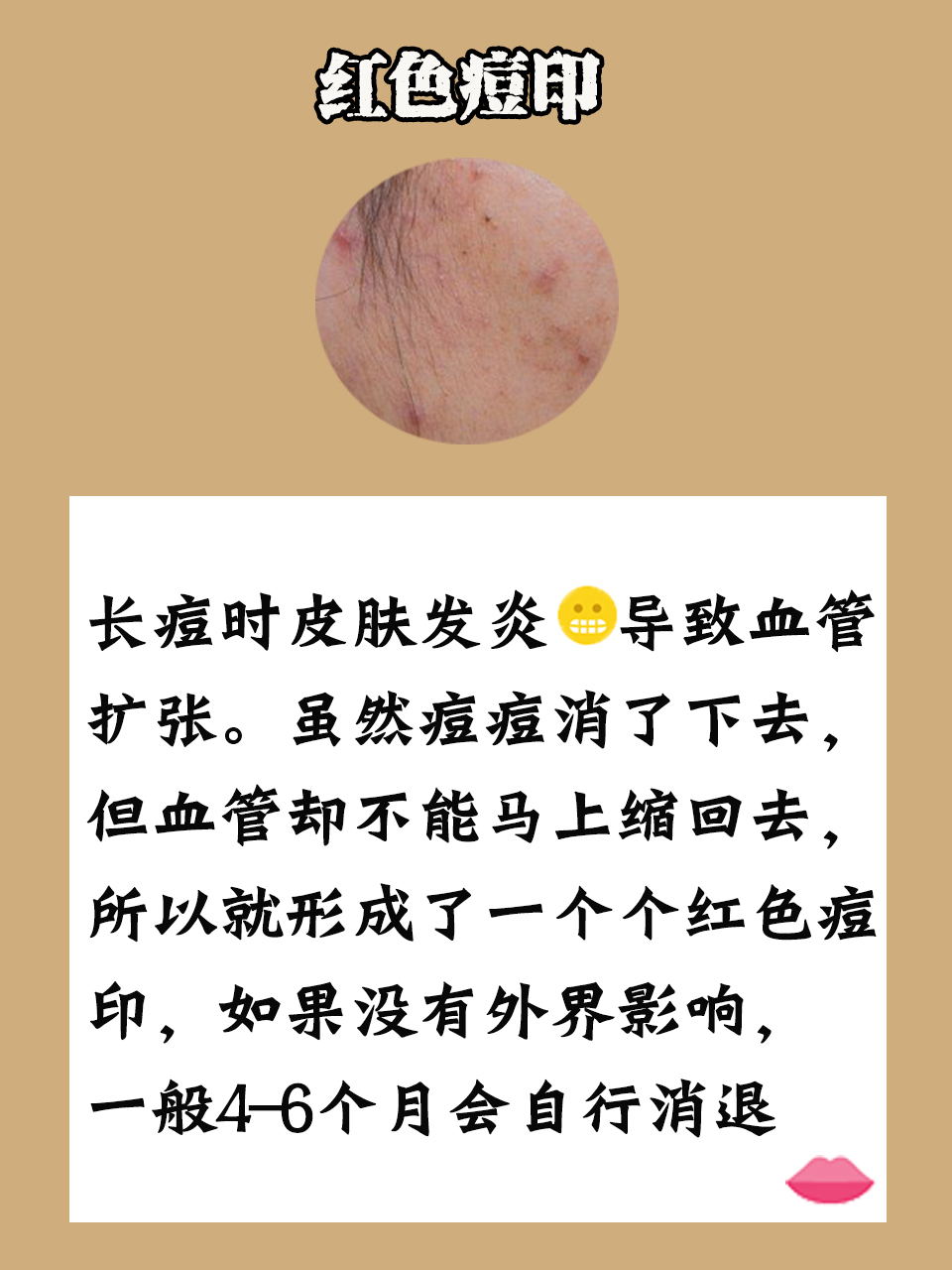 有什么祛痘印方法,简单有效祛痘印方法
