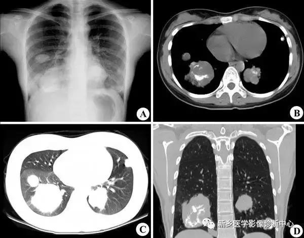肺部有球形病灶怎么治疗,肺内多发结节诊断早期肺癌怎么办