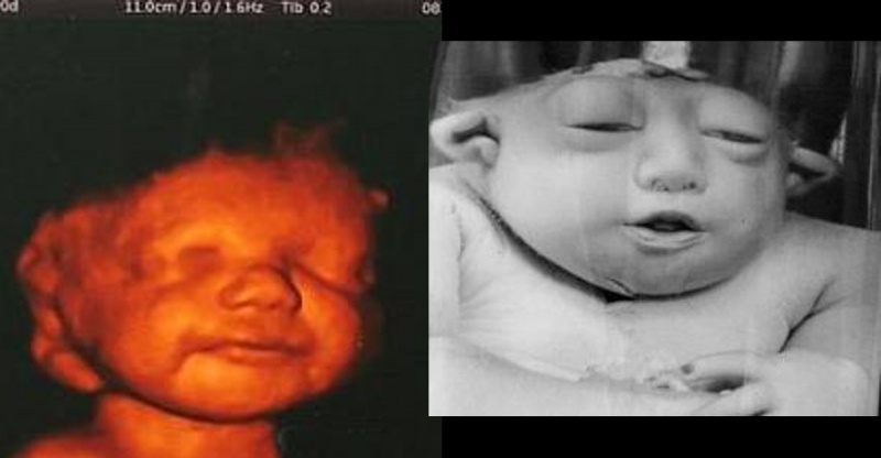 孕妇怀孕4周吃了禁用药能要吗,怀孕初期服了禁用的药会怎样