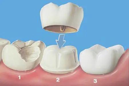 牙齿出现了隐裂有点酸感怎么办,牙齿隐裂不杀神经直接做牙套