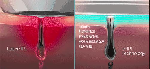 世界公认脱毛最有效的方法,目前最好的脱毛技术
