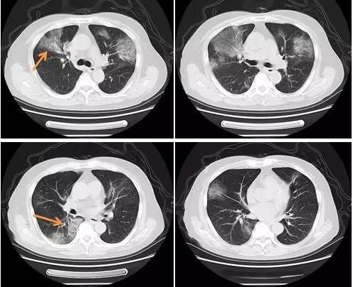 新型冠状病毒肺炎相关知识答疑,新型冠状病毒肺炎必须知道什么