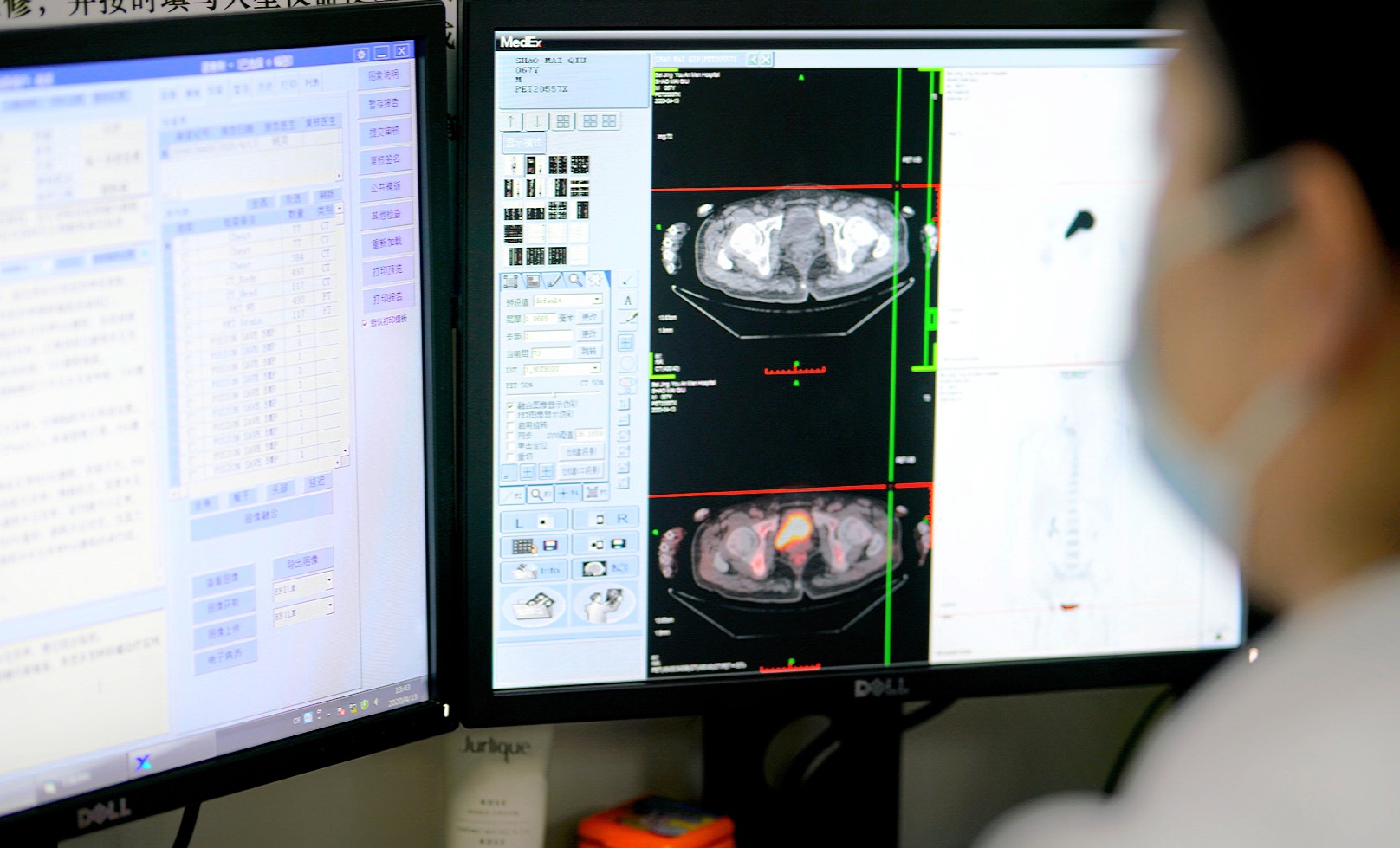 别再因为害怕放疗的副作用而拒绝治疗了