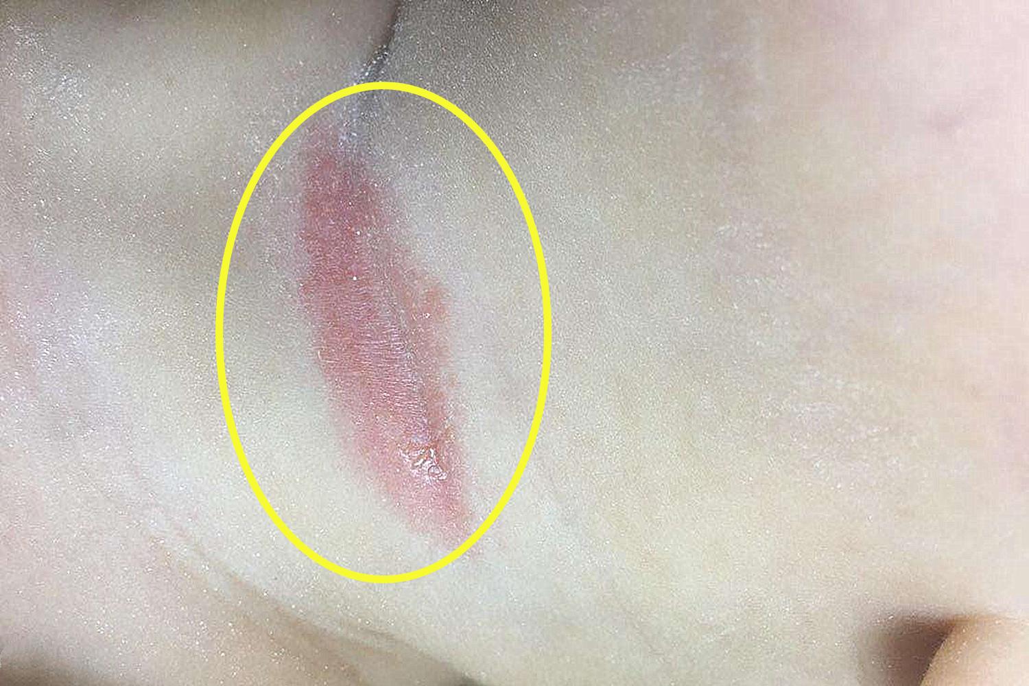 宝宝淹脖子妈妈饮食应该注意什么,宝宝淹脖子怎么护理