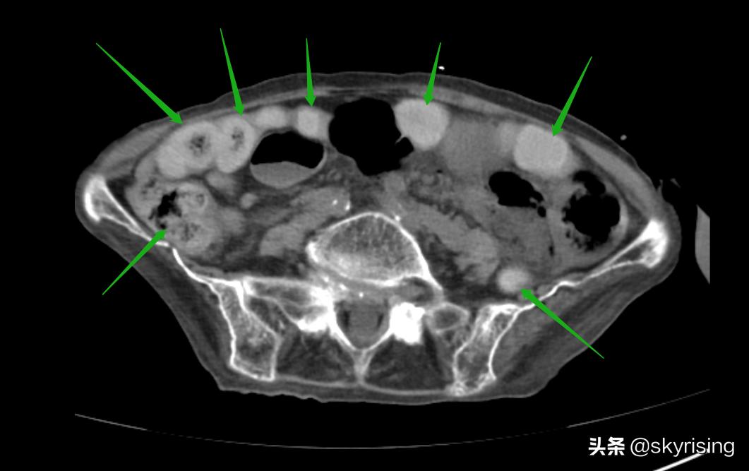 老人术后并发症,老年人术后风险有哪些