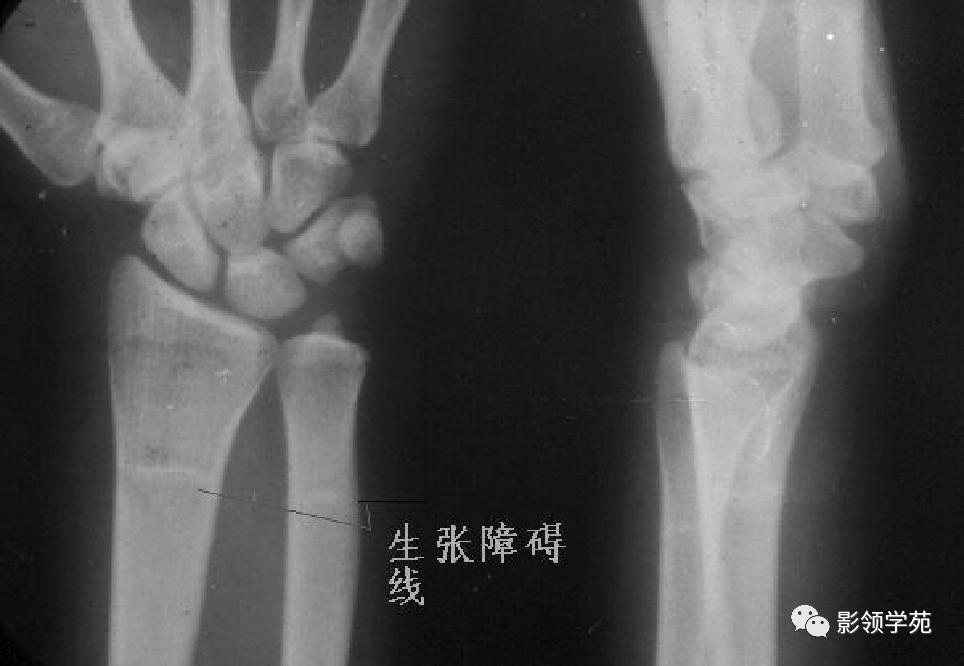 桡骨远端骨折引起尺骨变异,撕脱骨折一个月无明显骨痂形成