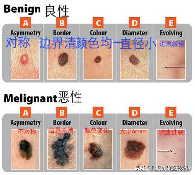 两毫米的痣医生要切,切痣医生怎么判断有没有切干净