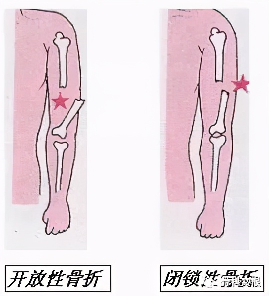 骨折了怎么一直不消肿吃什么药,骨折延缓愈合和骨不连的区别在哪