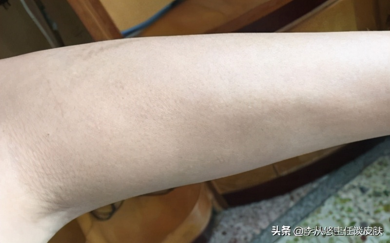 身上有几块白斑能被确诊白癜风,身上白色斑块怎么排除白癜风