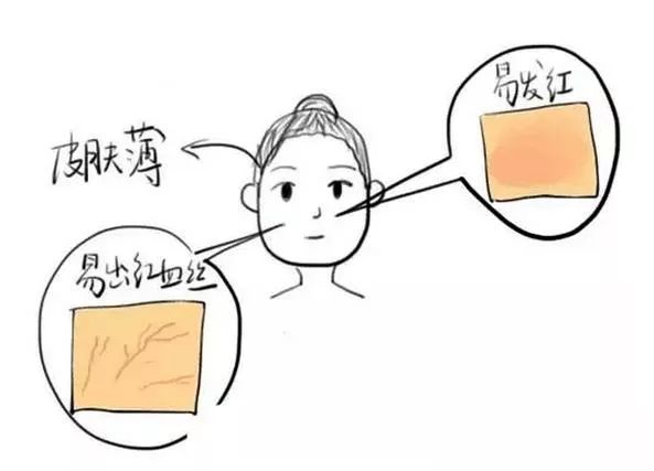 角质层薄脸上有红血丝怎么调理,角质层薄有红血丝脸发红怎么修复