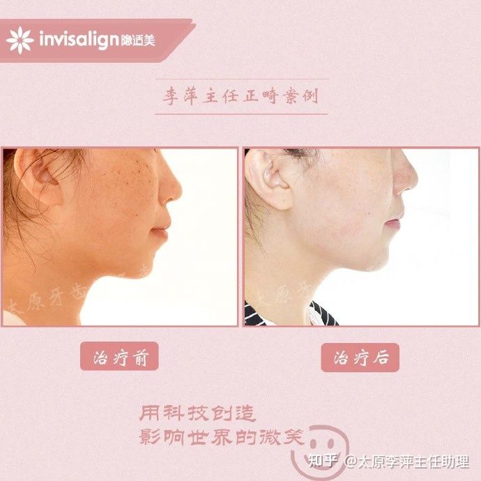 太原矫正牙齿需要做正颌吗,太原牙齿二次矫正