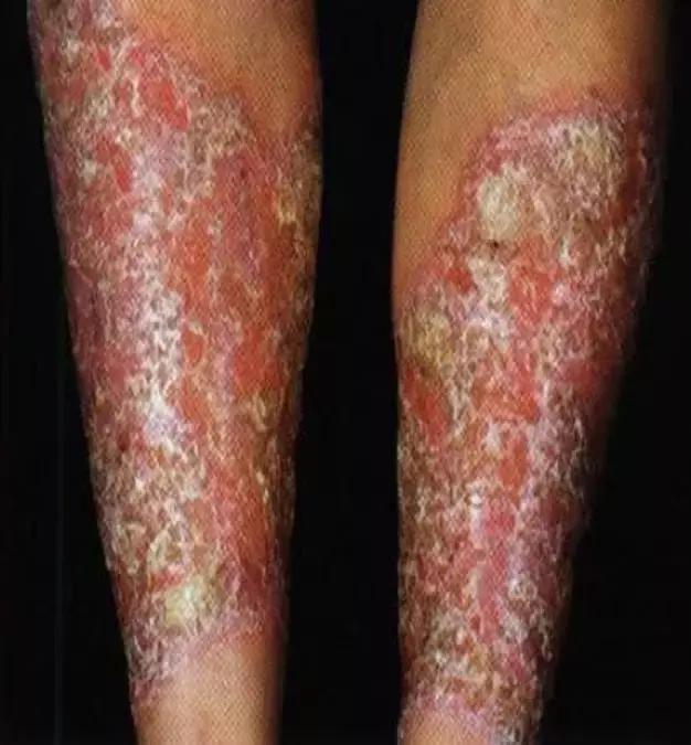 万古霉素治疗mrsa疗程,万古霉素用于mrsa的作用机制