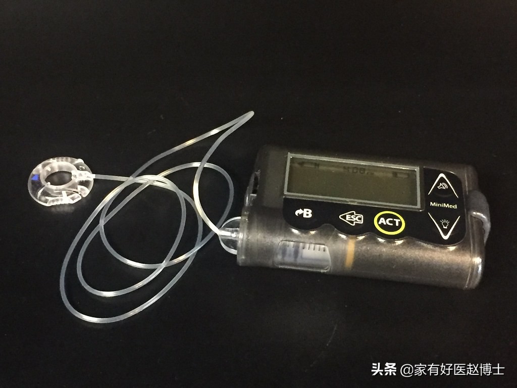 有没有人工智能胰岛素泵,人工胰岛素泵