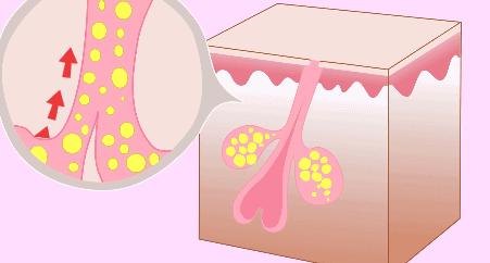 大油皮的坏处是什么,大油皮怎么处理