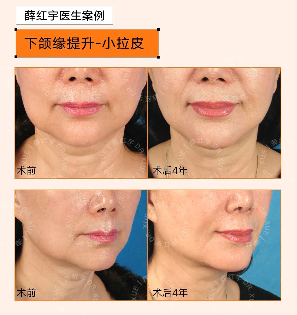 让下颚越来越清晰,下颌缘不清晰的原因