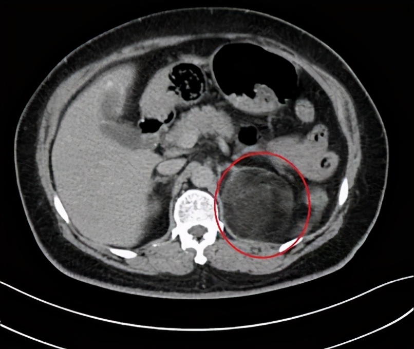 如何判断自己是不是满月脸水牛背,满月脸水牛背是什么原因引起的