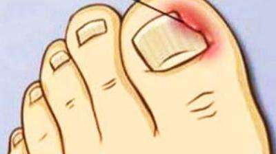 甲沟炎治好了以后怎么防止复发,甲沟炎的预防及有效处理方法