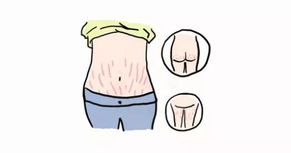 提前预知是否长妊娠纹,人身上妊娠纹