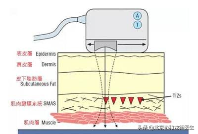 热拉提能紧致肌肤吗,抗衰老紧致皮肤方法