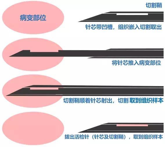 ct引导下穿刺活检诊断的分析,超声引导下穿刺活检什么样子的呢