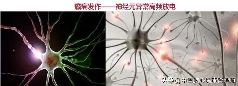 脑卒中后癫痫，如何正确使用抗癫痫药物？