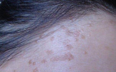 像老年斑一样的扁平疣怎么治,像斑一样的扁平疣