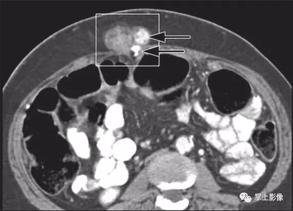 腹壁病变诊断思路,腹部影像诊断读片入门视频