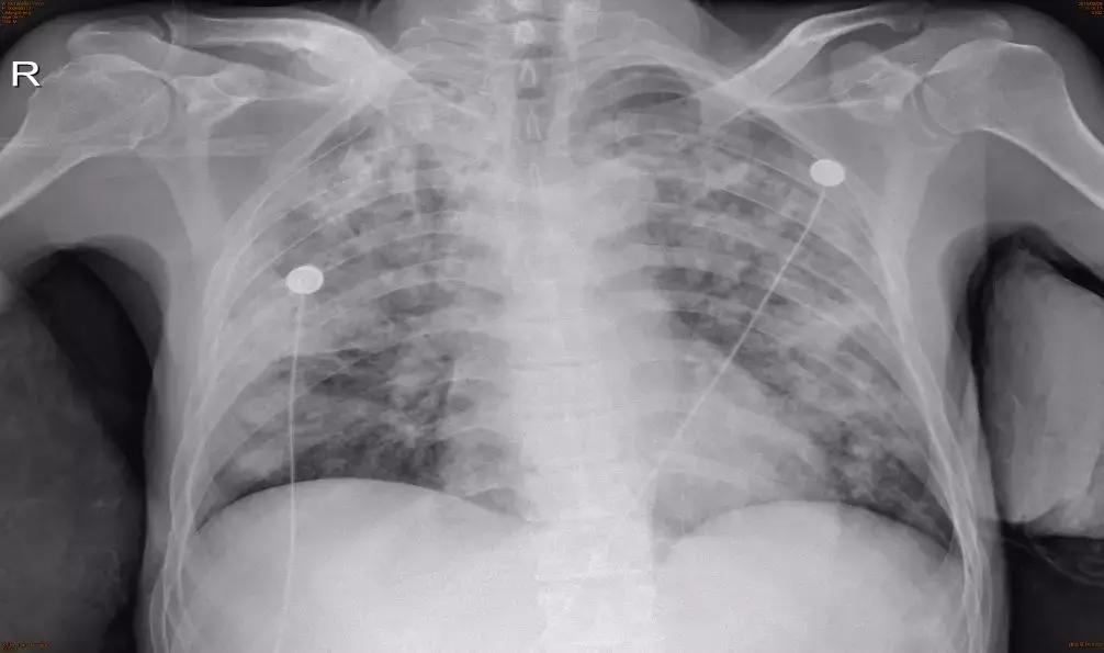 怎样确诊肺部真菌感染,侵袭性肺真菌病的确诊标准有哪些