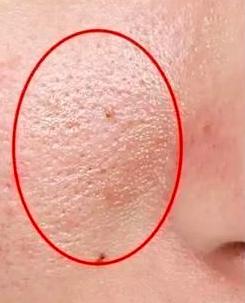 脸颊毛孔变粗有办法解救吗,脸颊器质性毛孔粗大