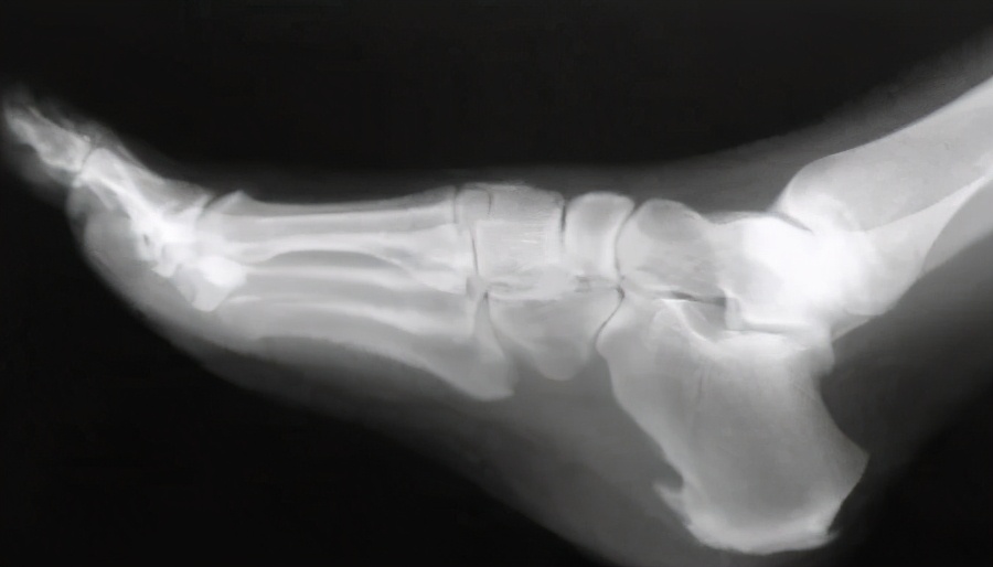 颈椎长了骨刺怎么办,脊柱长骨刺怎么办