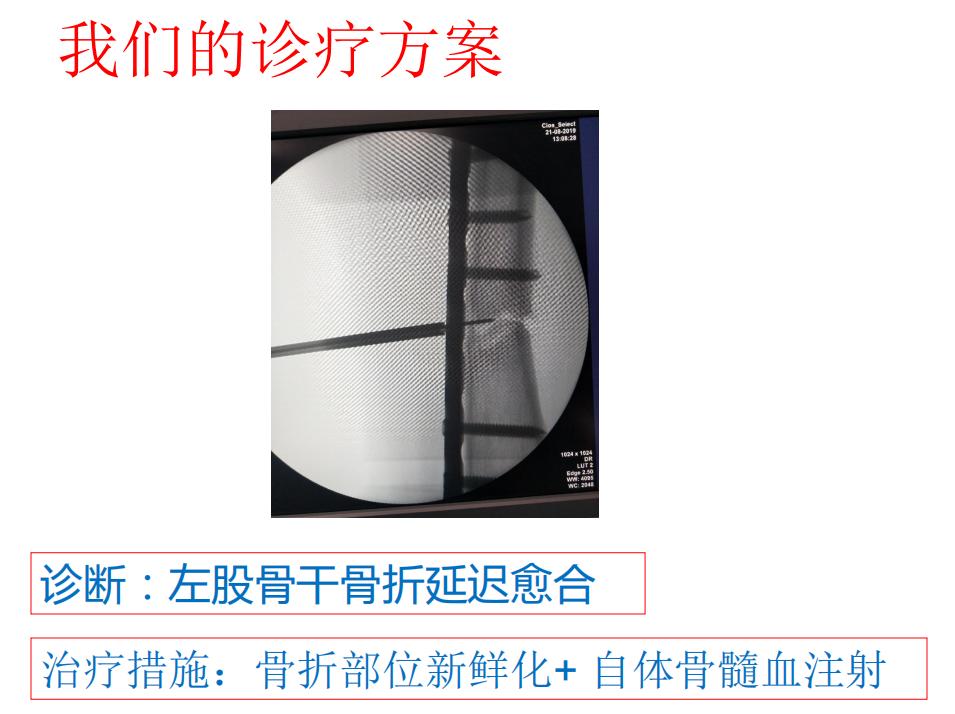 平乐骨科推拿教学,中医治疗骨折畸形愈合