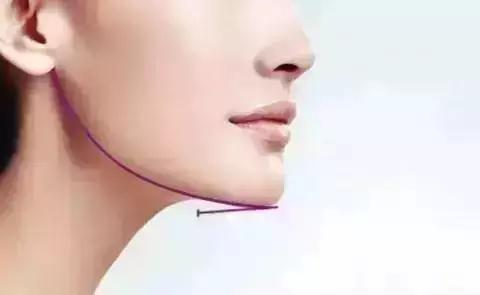 隆下巴后，整张脸都会变美了