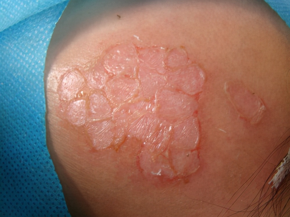 10600点阵激光治疗白癜风有效果吗,激光治疗白癜风能治好吗