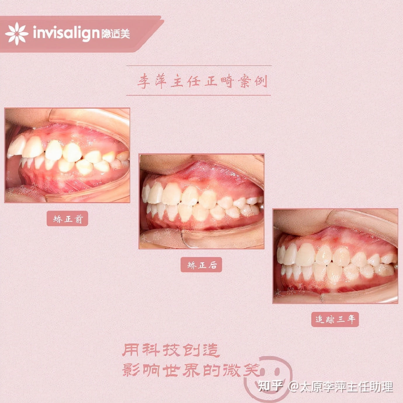 太原市牙齿正畸,太原市口腔正畸
